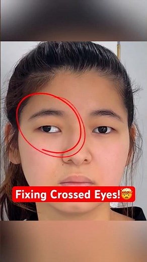 How Doctors Fix Crossed Eyes Fast