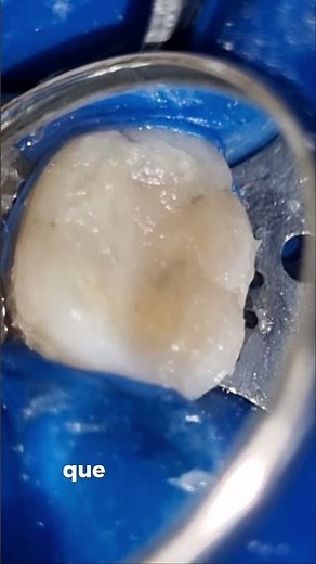 troca restauração de amálgama por resina #dentista #odontologia #canaldodente #dentes #resinacompost