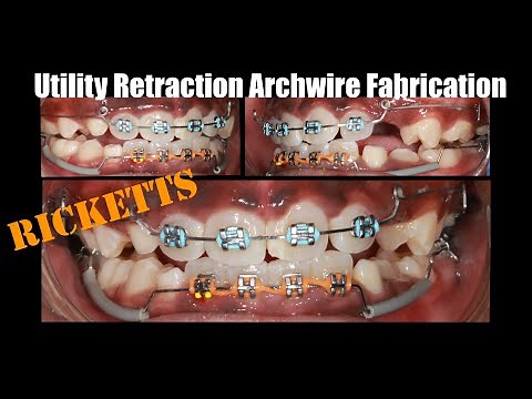 Ricketts utility retraction archwire fabrication and activation