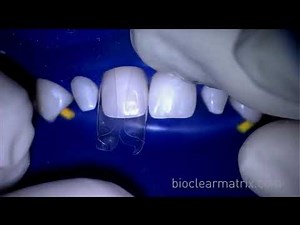 Bioclear Composite Veneers for Undersized Teeth Part 1