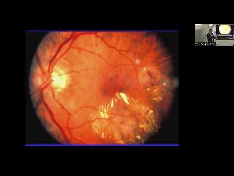 Lecture: Diabetic Retinopathy: Dr. David G Miller
