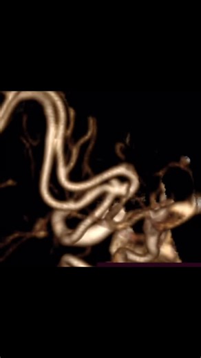 Dr.Vinayagamani on Instagram: "🧠 Brain Hemorrhage Awareness | Modern Treatment Saves Lives An elderly female with a ruptured ACOM aneurysm (wide-neck) presented with brain hemorrhage. She was treated successfully by Balloon-assisted endovascular coiling, achieving complete occlusion of the aneurysm with an uneventful recovery. ✔ No open brain surgery ✔ Minimal invasion ✔ Faster recovery ✔ High safety when done early Endovascular treatment is now the gold-standard lifesaving option for many pati