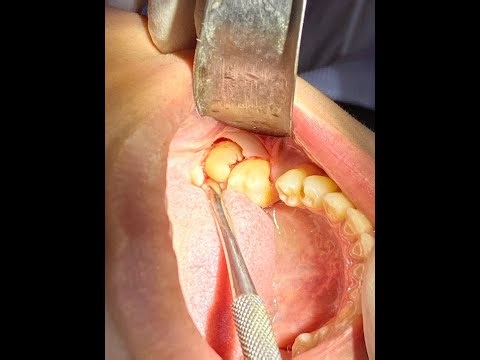 horizontally impacted lower wisdom