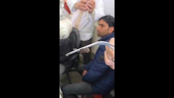 Doctors remove three-inch long leech from patient's nose in India