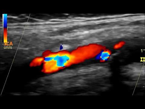 Carotid Doppler High Grade Stenosis Retrograde Vertebral Artery Flow