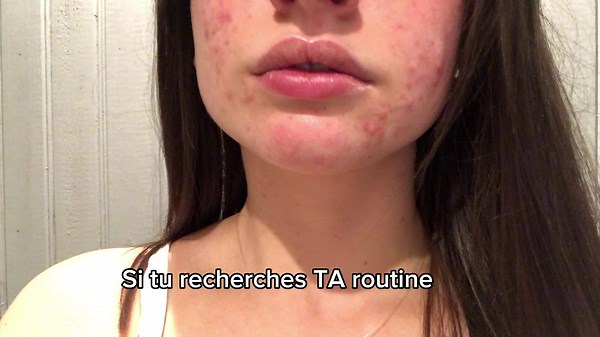 Il n’y a pas de produits miracles ! Simplement une routine adaptée à ta peau, tes habitudes ! Ma routine ne te conviendra peut être pas, et inversement ! C’est important de trouver la tienne ! Rejoins moi dans cette aventure des maintenant ! #skincare #pourtoii #fyp #acne