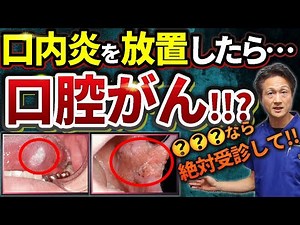 口内炎と口腔癌【要注意！異常から発症】初期症状と経過を歯医者が解説します！受診の目安,舌癌,痛み,しこり,腫れ,ただれ,出血