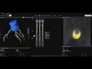 CCTA with HeartFlow AI: Basic Introduction (Plaque, Stenosis & FFR)
