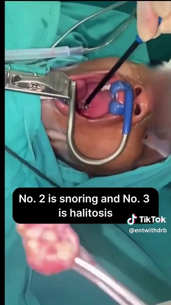 Top Reasons for Tonsillectomy: Relief from Snoring & More