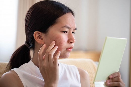 Stress Causing Your Pimples? Here’s How To Get Rid of Them