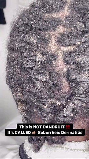 Understanding Seborrheic Dermatitis with Locs: Causes and Treatment
