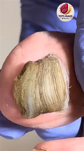 12K views · 144 reactions | Swelling-care toenail plans with easy home-based support  #ToenailCareGuide #DailyWellness #HomeNailCare | Tots Mags Wheel | Facebook