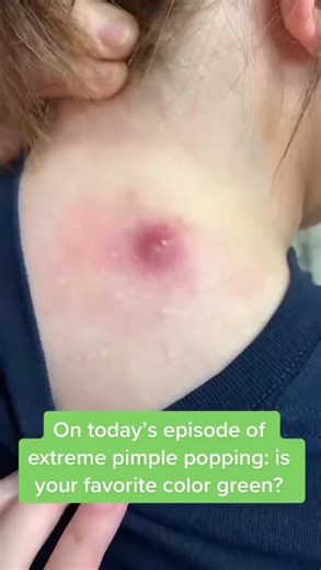 sac dep spa Relax Pimple Popping, Cysts, Spots 2023 #satisfying #shorts #blackheads #pimplepopping #asmr #acnetreatment #viralvideo