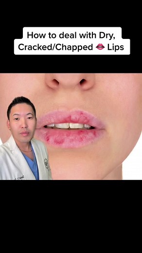 Tips for Treating Dry Cracked Lips