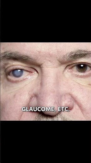 Hallucinations and Charles Bonnet syndrome