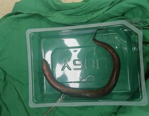 Doctors shocked after finding live eel inside man suffering severe abdominal pain