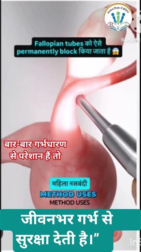 Permanent Birth Control | महिला नस बंदी: स्थायी गर्भ निरोधक तरिका |Tubectomy Surgery #shorts ,