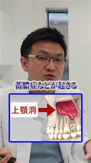 痛くない、腫れない【上顎の骨造成】インプラント最新治療 切り抜き #インプラント #歯医者 #相場 #むし歯