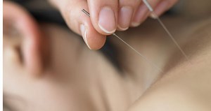 Acupuncture : bienfaits, indications, coût