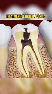 5.8K views · 42 reactions | Toothache is often due to pulpitis #medical #dentist #learnontiktok | T.Medical.V | Facebook