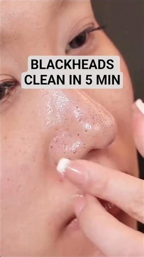 Sirf 1 Use Me Blackheads Gayab | Home Remedy For Nose