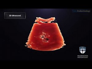 Diagnosis of Thyroid Nodule with New Ultrasound Imaging Modalities