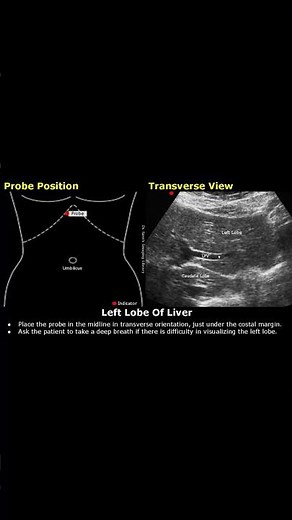 Left Liver Lobe Probe Positioning | Liver Ultrasound Transducer Placement | How To Scan USG #shorts