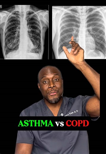 Asthma and COPD might look similar at first glance, but they’re totally different. One is reversible. The other causes permanent lung damage. Let’s break it down. #LungHealth #AsthmaVsCOPD #ChestXray #RespiratoryFacts #MedicalEducation Disclaimer: This content is for educational purposes only and should not be used as a substitute for professional medical advice, diagnosis, or care.
