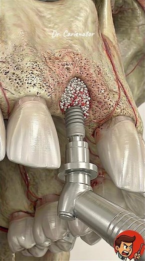 How a Dental Implant ACTUALLY Works!