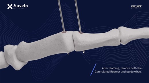 Thumb Collateral Ligament Reconstruction: 3D Surgical Technique A step-by-step visual guide demonstrating 3×8 mm Interference Screw fixation with BioBraid SutureTape. Ideal for surgeons seeking precision, minimal disruption, and dependable ligament reconstruction outcomes. #HandSurgery #Orthopaedics #LigamentReconstruction #ThumbUCL #InterferenceScrew #SutureTape #SurgicalEducation #3DAnimation #Auxein #MedicalDevices | Auxein