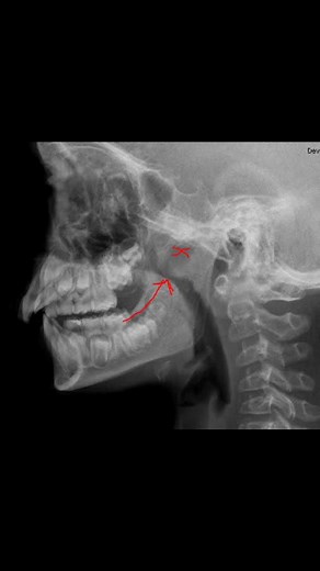 1.5K views · 47 reactions | Surgery day for Simon. ‍⚕️ His adenoids...