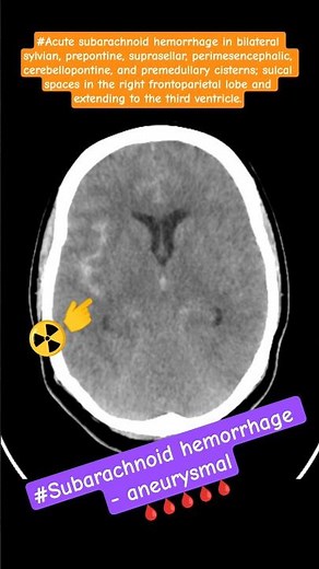 #Subarachnoid Hemorrhage (SAH) | CT Scan Findings Radiology Explained#shortvideo