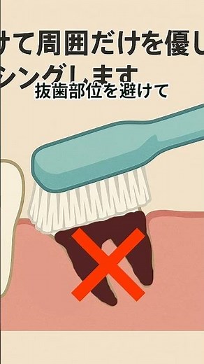 親知らず抜歯後にできた穴が心配な方へ｜治癒期間とトラブル対策ガイド #親知らず抜歯後穴 #血餅