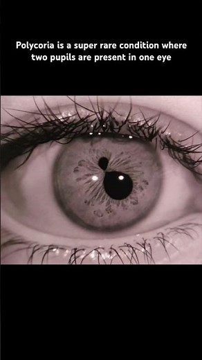 Polycoria is a super rare condition where two pupils are present in one eye #eyes #science