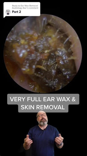 Incredible Ear Wax & Skin Removal Process - Part 2