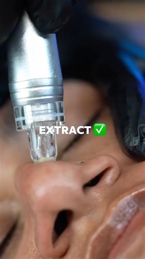 Blackheads vs. Inflammatory Acne ❌ Not all breakouts should be treated the same way. • Blackheads → can be safely extracted with a skin scrubber or HydroDiamond® technology for clean, smooth pores. • Inflammatory acne → never squeeze! Better to calm with cryotherapy (cold therapy) to reduce redness & inflammation. The secret? Choosing the right technology = faster healing healthier skin. ✨ Share this with your esty bestie so they never make the mistake of popping again! #Blackheads #AcneTreatmen