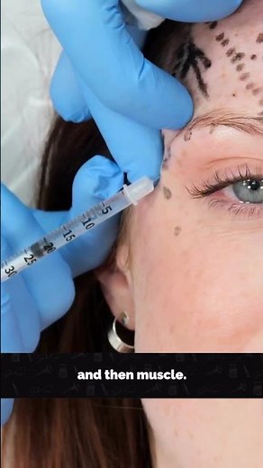 Botox brow lift injection depth