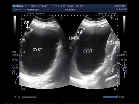 Ultrasound Video showing a large Hepatic hydatid Cyst.
