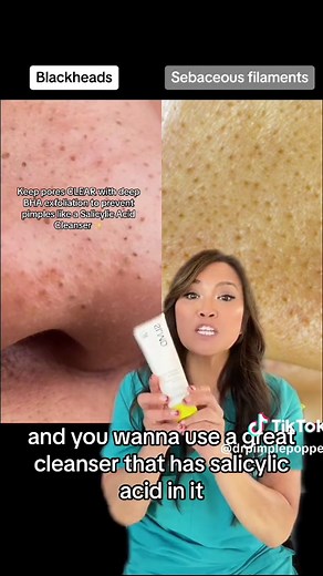PSA: Use a good salicylic acid cleanser like @SLMD Skincare to keep those comedones away and sebaceous filaments under control! #drpimplepopper #SLMDskincare