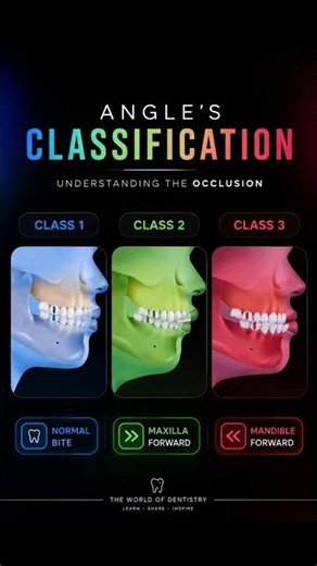 🦷 Angle's Classification Explained Simply | Class I, II & III Malocclusion #dental