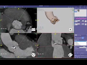 Cusp Overlap view for TAVR. Manual workflow. Intuition from Terarecon
