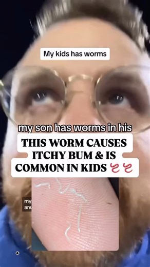 16yr Certified Strength Coach & Detox Educator|Sarah Wohlgemuth on Instagram: "Pinworms are one of the most common parasitic infections in North America - especially in kids and yet most parent are not told about them or aware If your child has: • Nighttime bum itching • Restless sleep • Grinding teeth • Irritability • Tummy discomfort • Scratching + nail biting habits then there’s a good chance pinworms are the culprit . They spread FAST, they reinfect easily, and they’re incredibly common in s