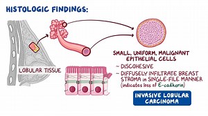 Video: Invasive lobular carcinoma: Clinical sciences - Video Explanation! | Osmosis | Osmosis