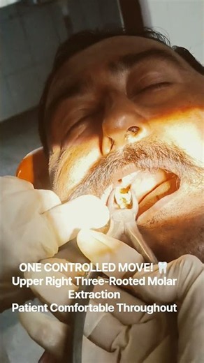 Three-Rooted Molar Extraction 🦷 | One Controlled Move!#TheDentalGuru