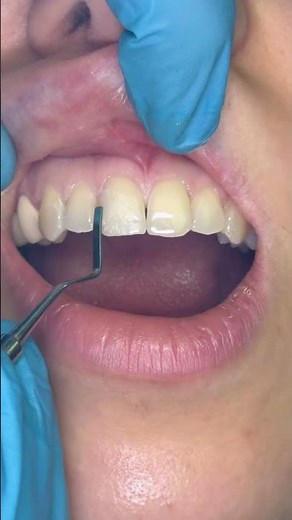 Anterior Composite Restoration