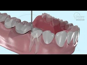 Endodontie und tiefe Hohlräume. 3D Was es ist und wie es gemacht wird. 3D.