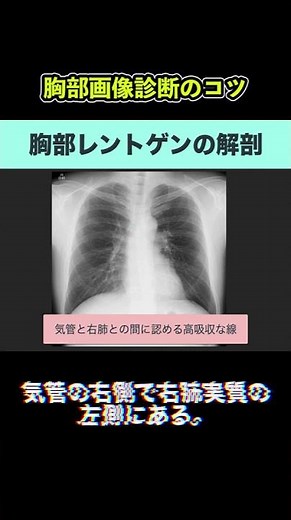 胸部レントゲンの正常解剖：右気管傍線（その1）【胸部画像診断のコツ】#shorts