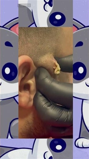 🔥Deep Blackheads, Milia & Whitehead Removal pimple popping New| Big Cystic Acne Extraction