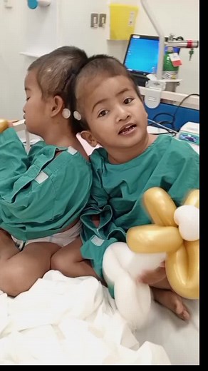 Cerebral Angiogram Procedure for Conjoined Twins
