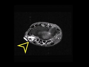 Wrist MRI: Ganglion Cyst Wrapped Around Radial Artery